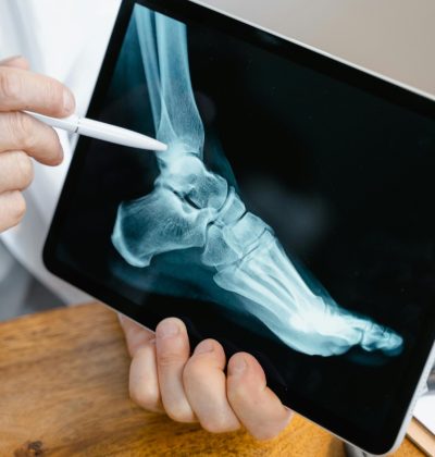 Sănătate și accidente Close-up of a doctor examining a foot x-ray on a tablet, using a stylus for demonstration.