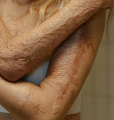 Sănătate și accidente Detailed close-up of a woman's arm with burn scars, symbolizing resilience and healing.